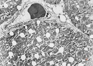 F,58y. | myocardial steatosis